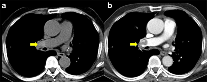 Pulmonary Embolism Detection